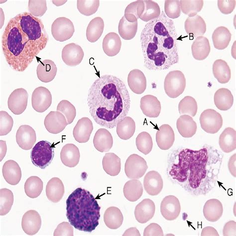 Segmented neutrophils (segs) .